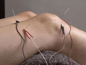 Elektro-Acupunctuur bij Knie klachten